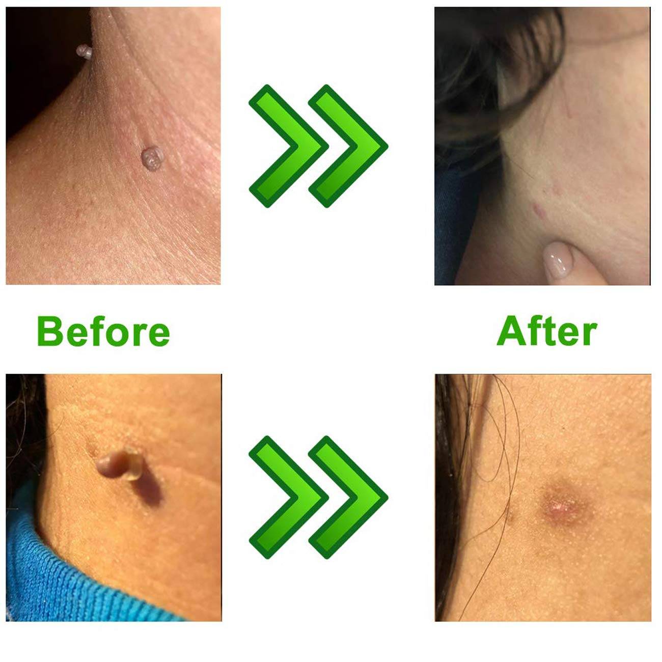 Skin Tags befor and after treatment